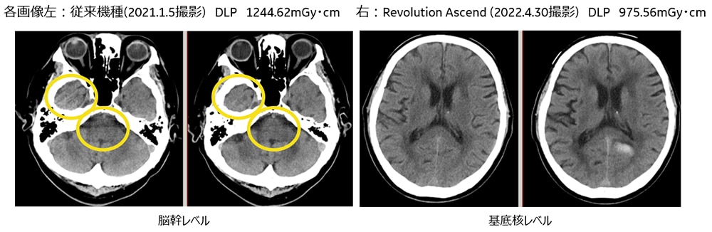 Revolution Ascendがもたらす臨床的インパクト | GE HealthCare